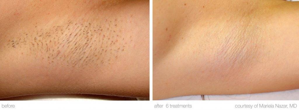 IPL Laser Hair Removal Los Angeles | Beach Cities Vein and Laser