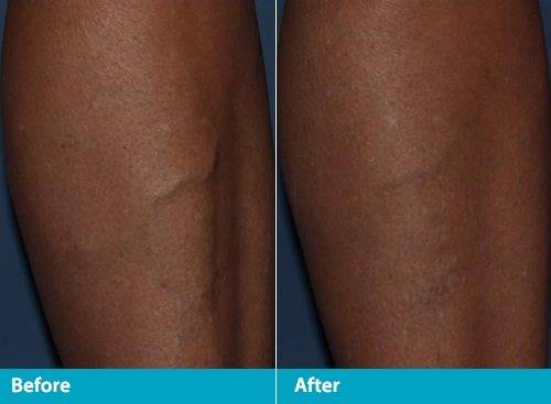 ultrasound guided sclerotherapy, Ultrasound Guided Sclerotherapy