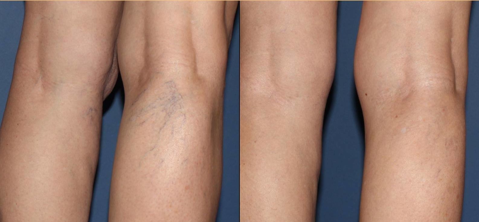, Sclerotherapy