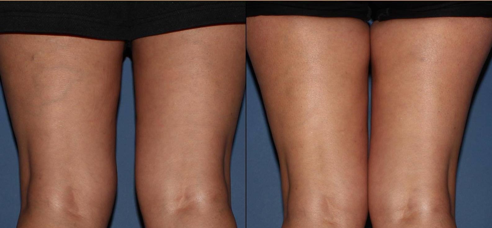 , Sclerotherapy