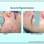 Acne Pigmentation 150x150