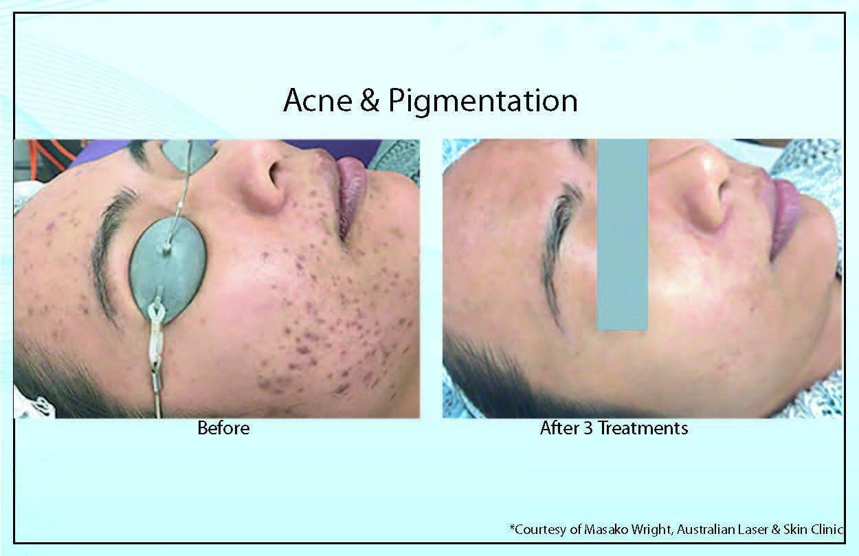 Acne Pigmentation