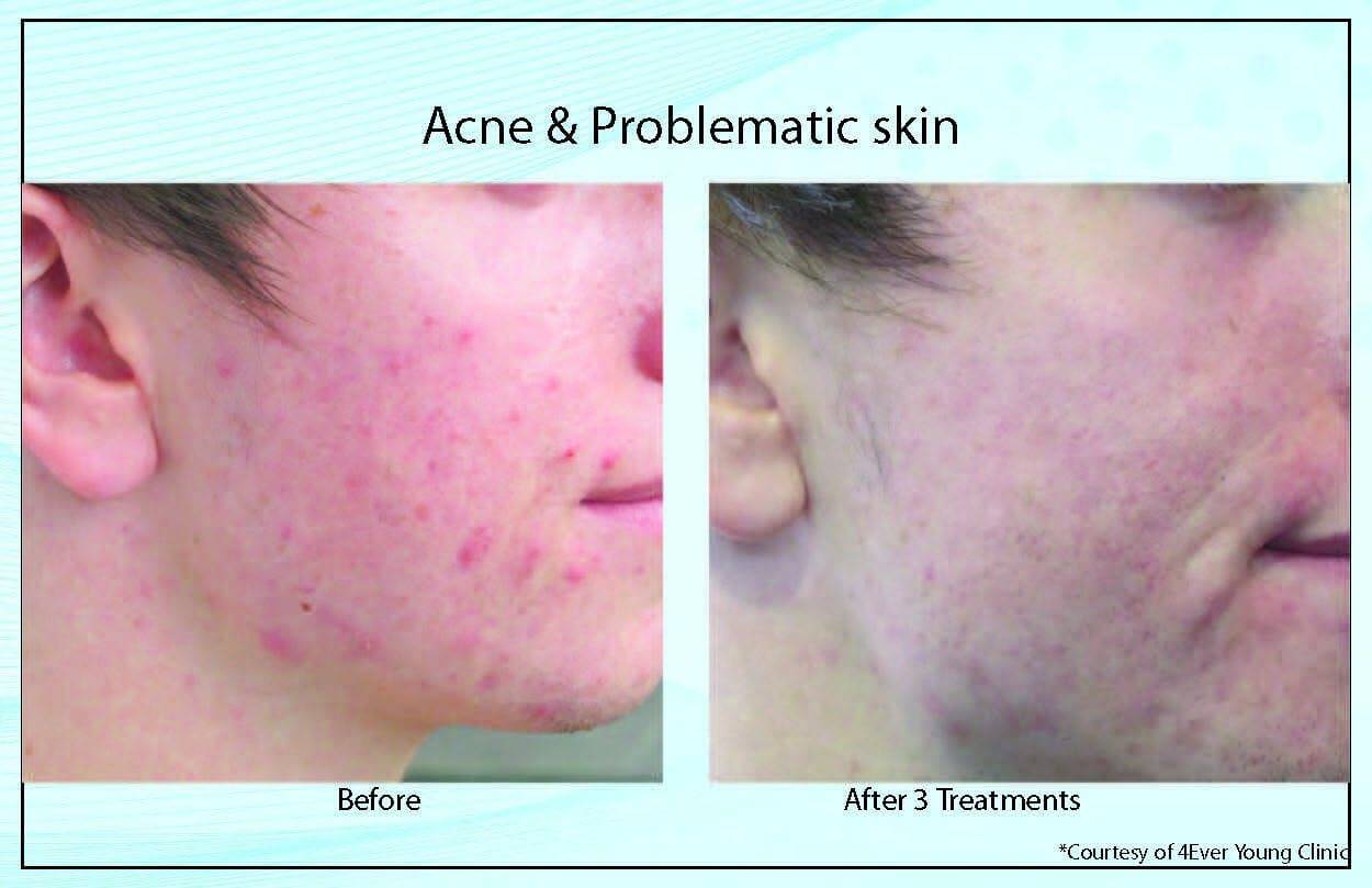 Acne ProblematicSkin2