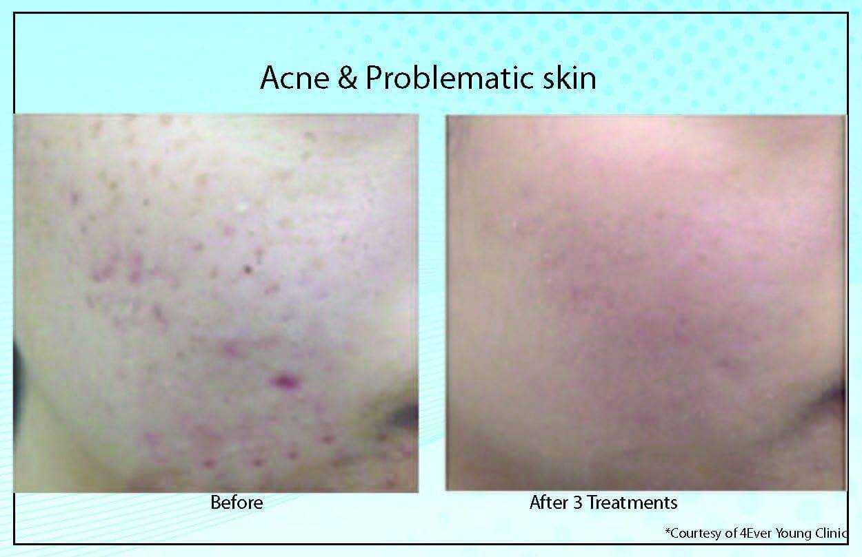 Acne ProblematicSkin4