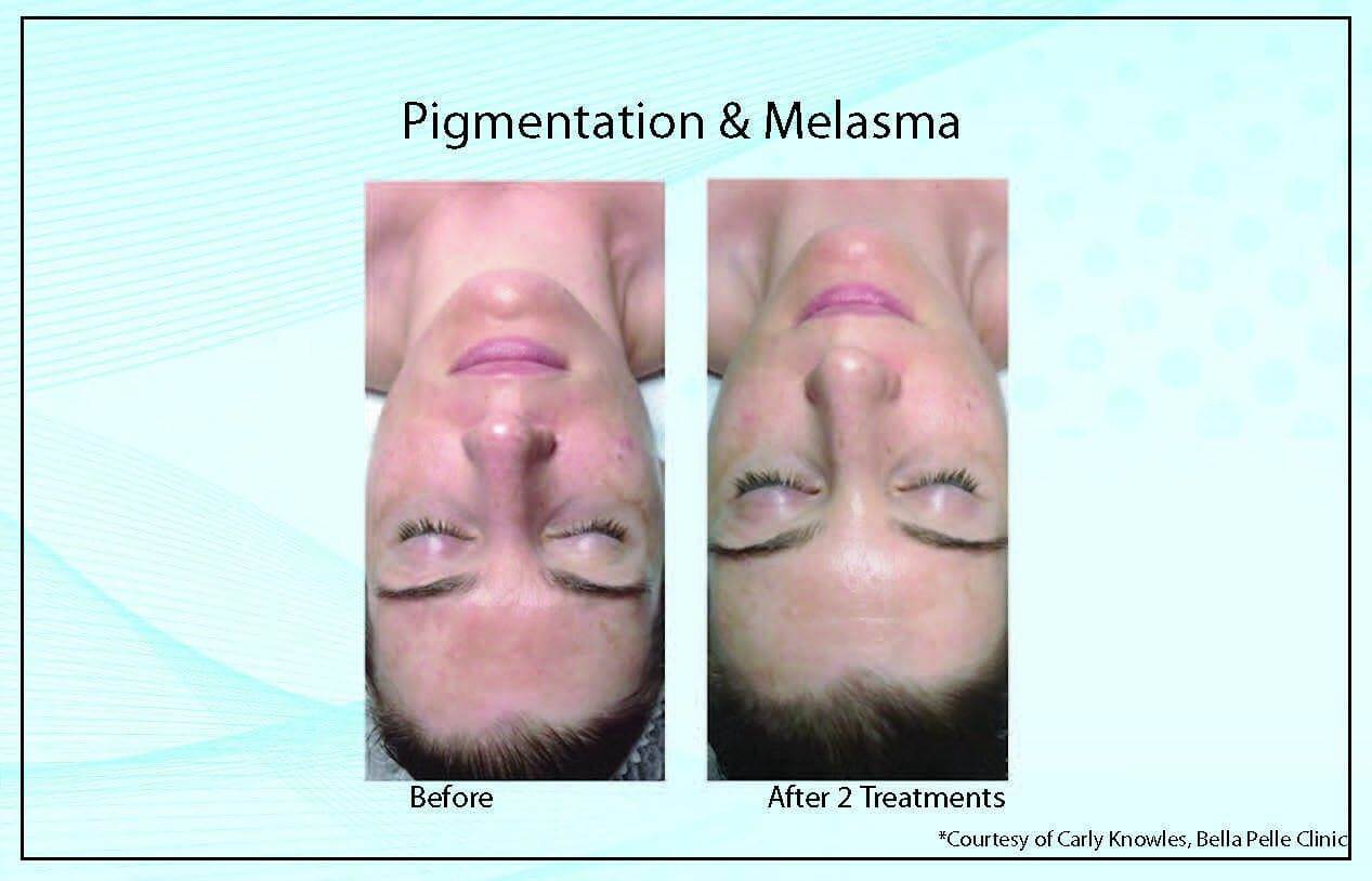 Pigmentation Melasma1