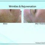 Wrinkles Rejuvenation 150x150