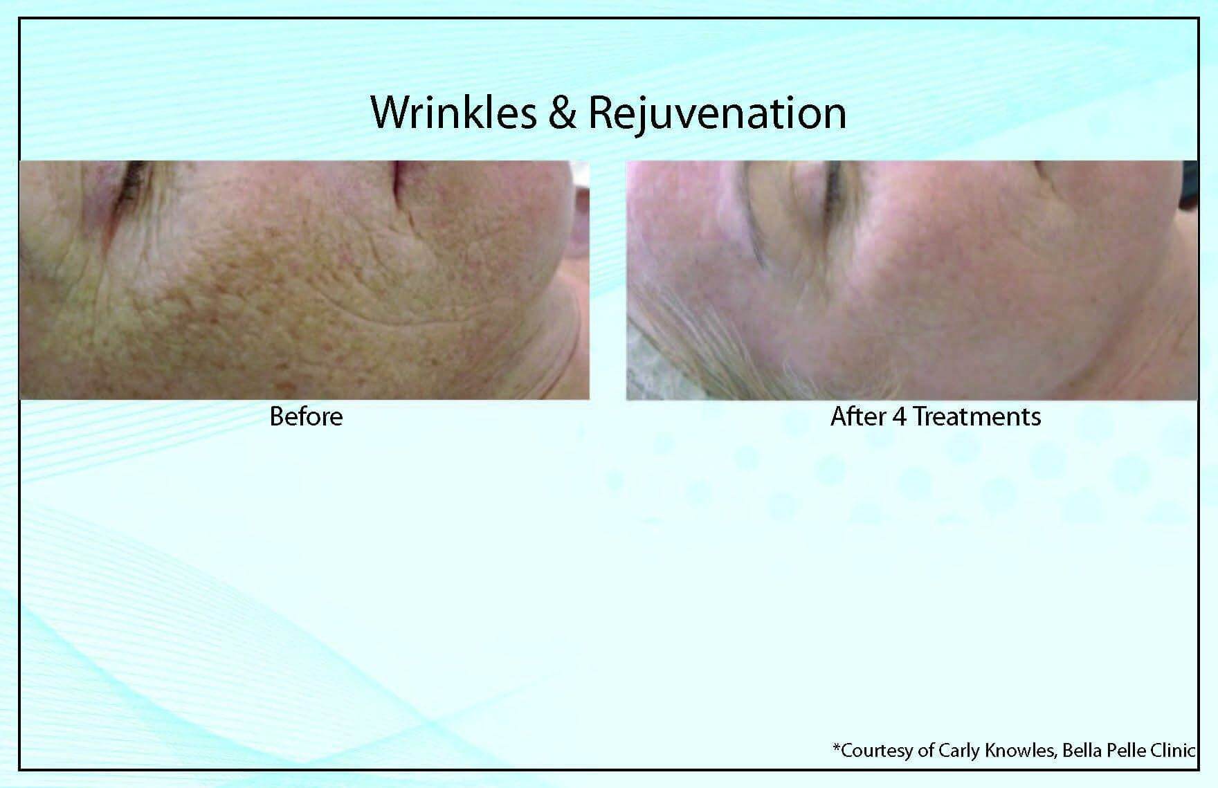 Wrinkles Rejuvenation