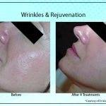 Wrinkles Rejuvenation2 150x150