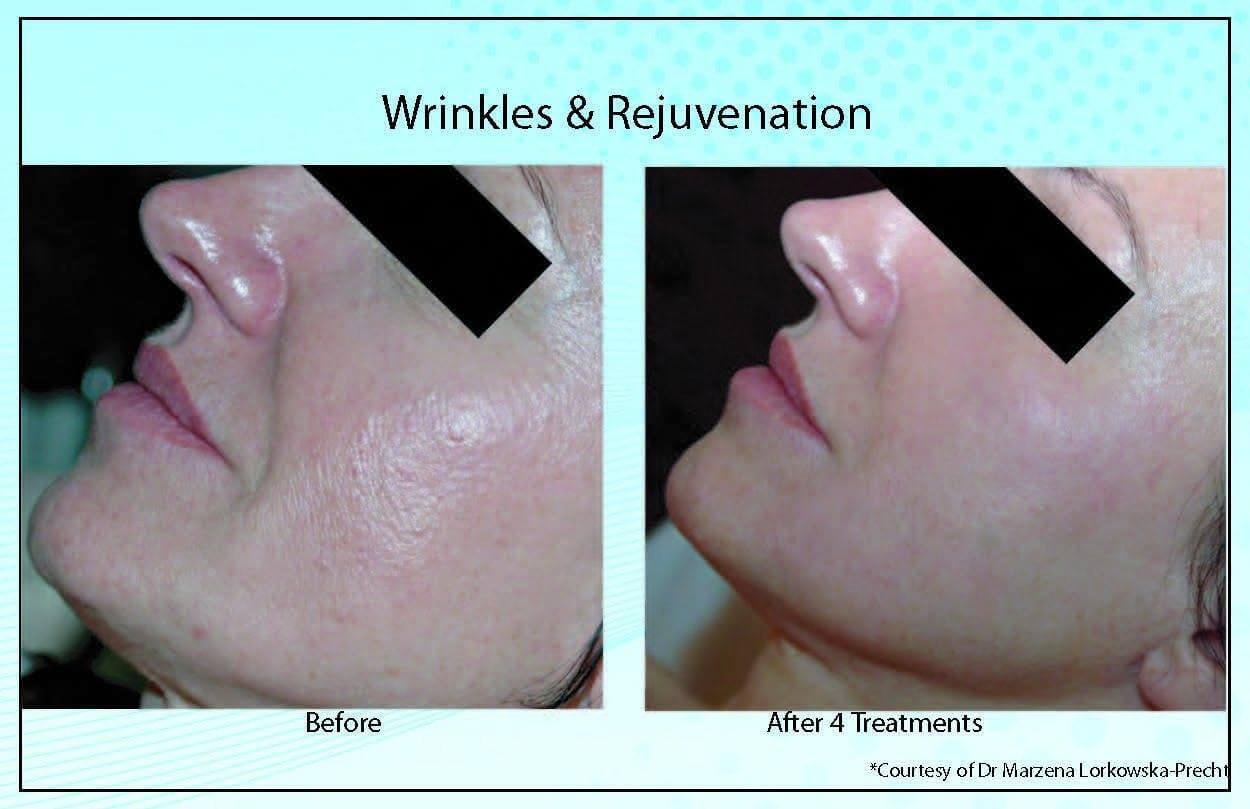 Wrinkles Rejuvenation2