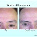 Wrinkles Rejuvenation3 150x150