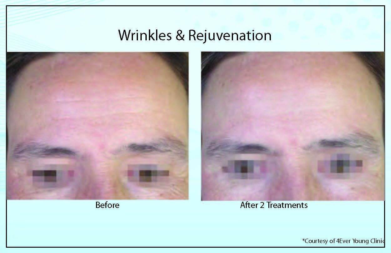 Wrinkles Rejuvenation3