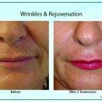 Wrinkles Rejuvenation4 150x150