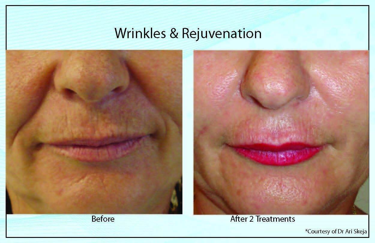 Wrinkles Rejuvenation4