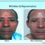 Wrinkles Rejuvenation5 150x150