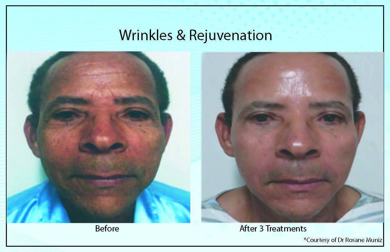 Wrinkles Rejuvenation5