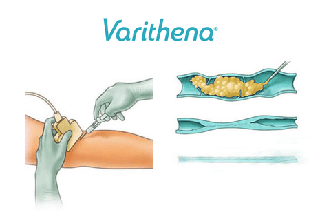 Varithena