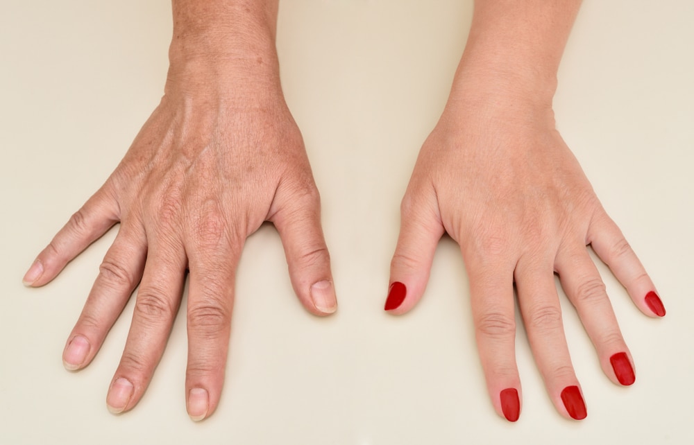 What Are the Benefits of Hand Rejuvenation? | Beach Cities Vein and Laser Center