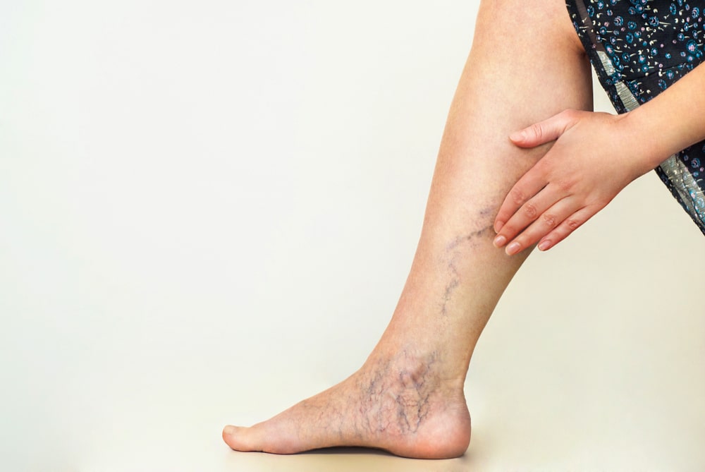 Exploring the Development of Varicose Veins: Factors and Prevention | Beach Cities Vein and Laser Center