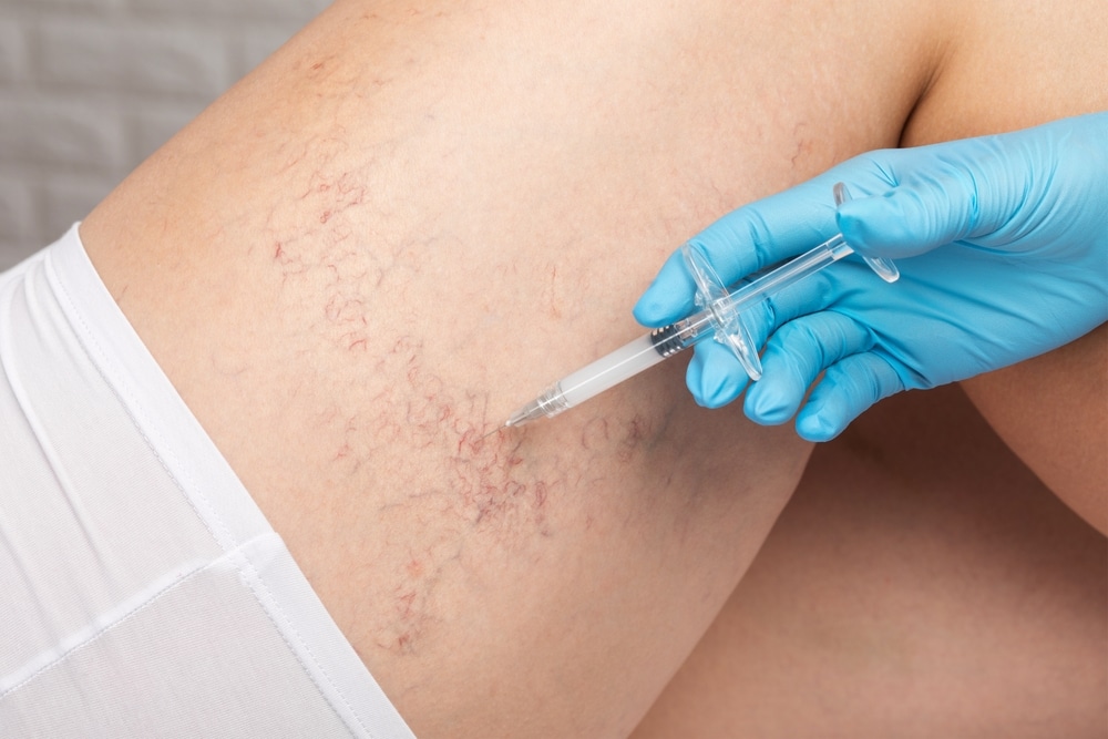 If you would like to know more about this treatment, contact us online or call us at (310) 906-2287 to schedule your initial consultation. | Beach Cities Vein and Laser Center