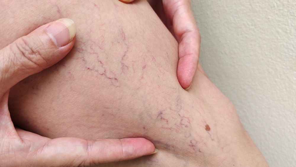 A Comprehensive Look at Varicose Vein Removal: Deciphering the Benefits Involved With the Treatment | Beach Cities Vein & Laser Center